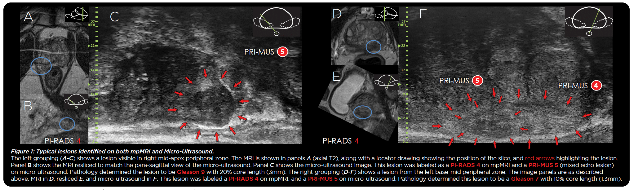 Comparison of Micro-Ultrasound and Multiparametric MRI Imaging for Prostate Cancer: An International Meta-Analysis